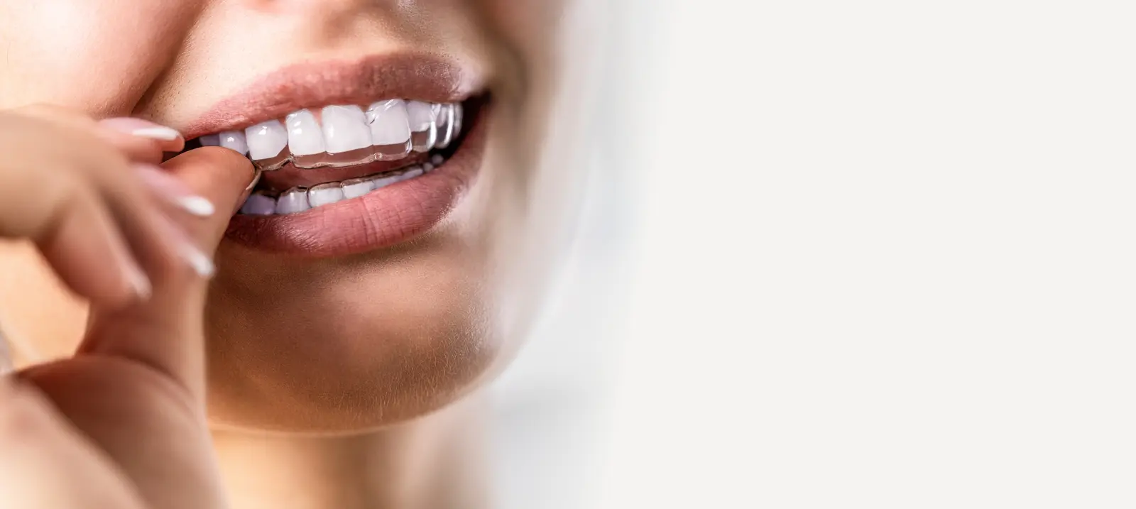 Closeup image of a person putting aligners on